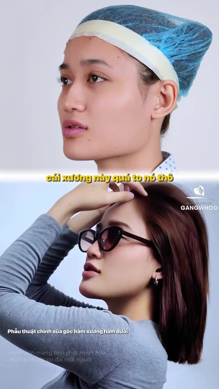 Ứng dụng công nghệ nội soi trong gọt hàm giúp đường mổ nhỏ, tối ưu thời gian hồi phục và kết quả đẹp tự nhiên.