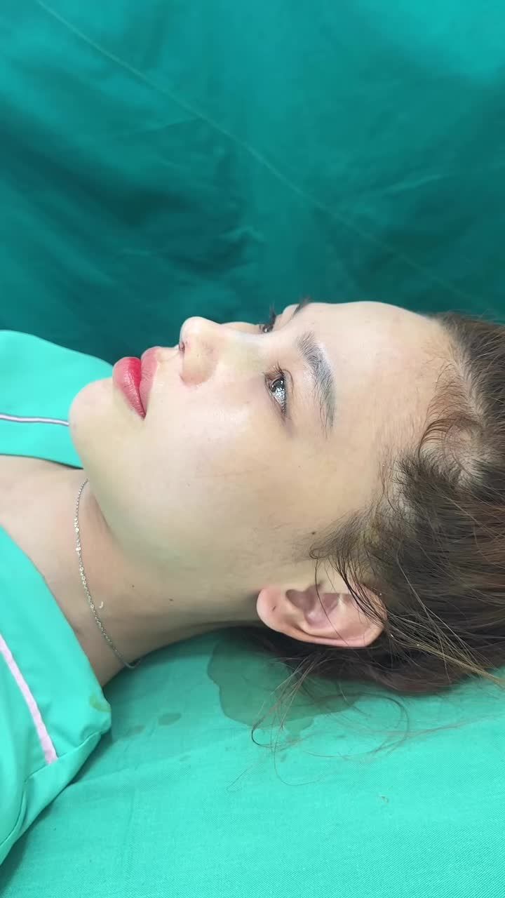 NÂNG MŨI CẤU TRÚC HOÀN THÀNH SAU 90 PHÚT!!