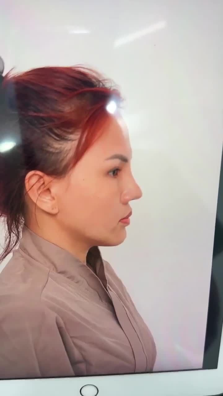 KẾT QUẢ SAU 60 PHÚT NÂNG MŨI CẤU TRÚC - SỬA LẠI MŨI HỎNG KH. MỸ LỆ (ĐỒNG THÁP)