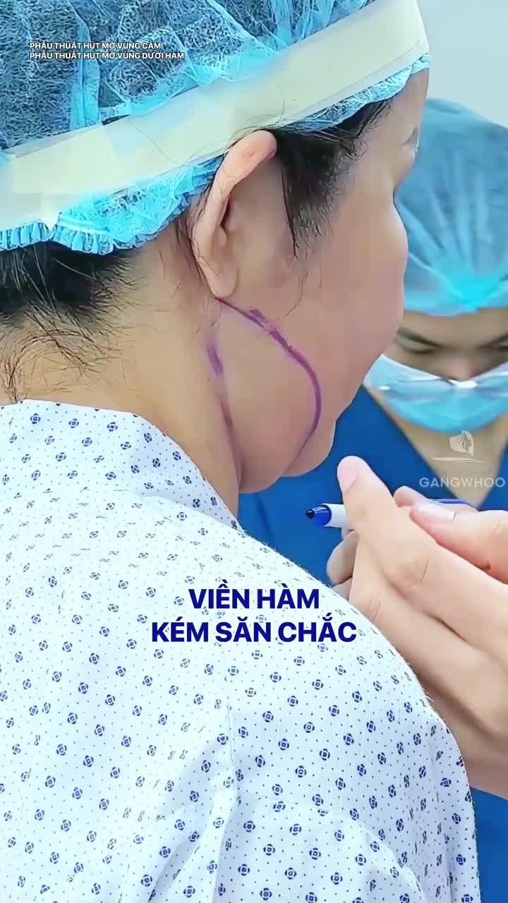 Top những điều chị em muốn “tạm biệt” để tự tin hơn → Top 1: Nọng cằm