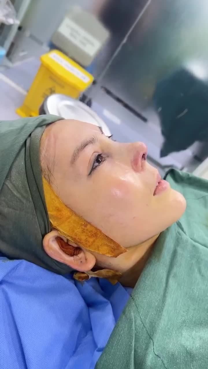 KẾT QUẢ SAU 60 PHÚT NÂNG MŨI CẤU TRÚC - SỬA LẠI MŨI HỎNG KH. CHEN JIA JU (ĐÀI LOAN)