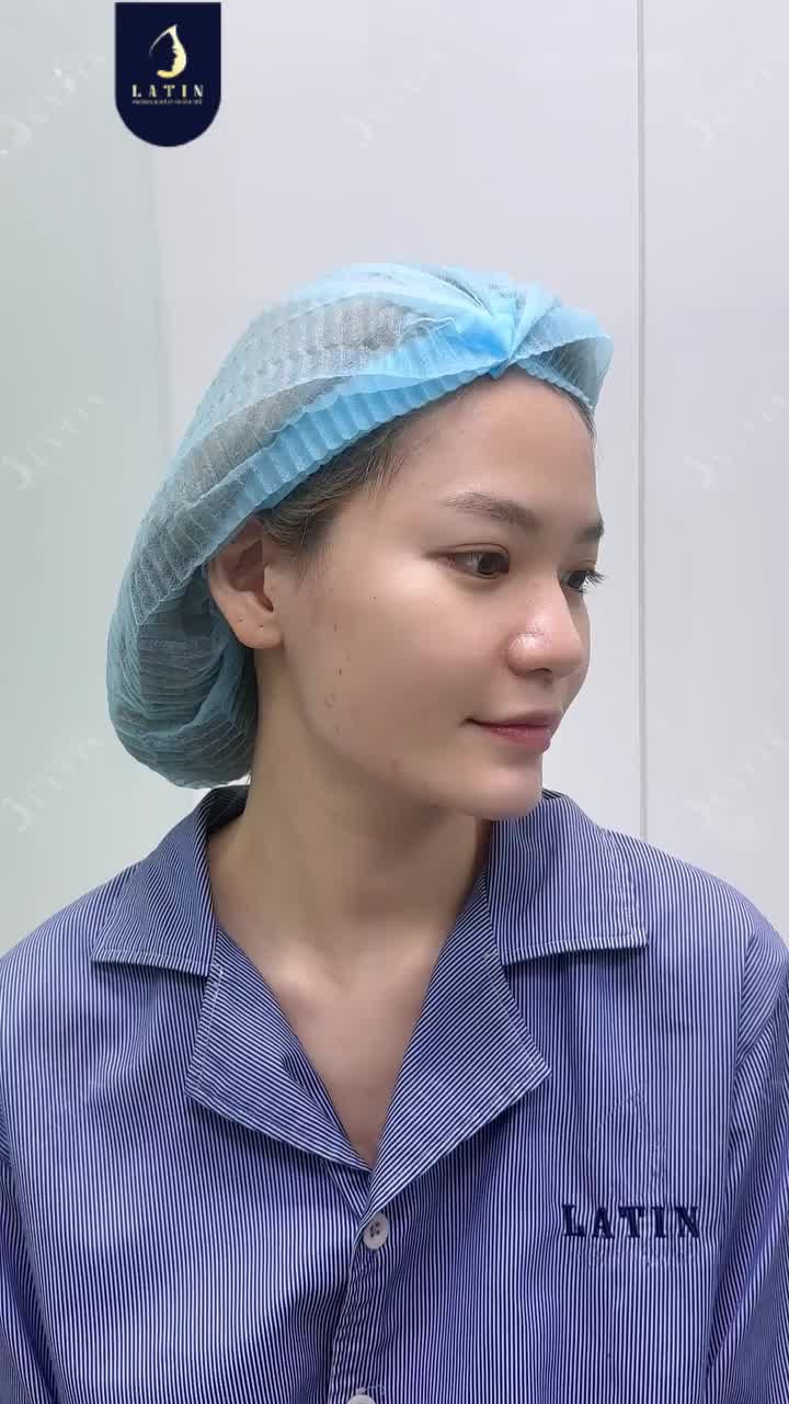 MŨI ĐẸP TỰ NHIÊN - KHÔNG CẦN NÂNG SÓNG
