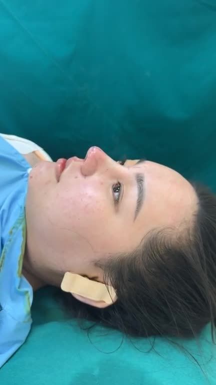 NÂNG MŨI CẤU TRÚC – VỪA HOÀN THÀNH