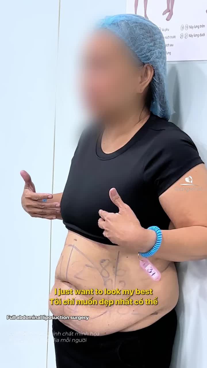 Sự hài lòng của nữ khách Quốc tế Úc sau giảm mỡ bụng tại Gangwhoo