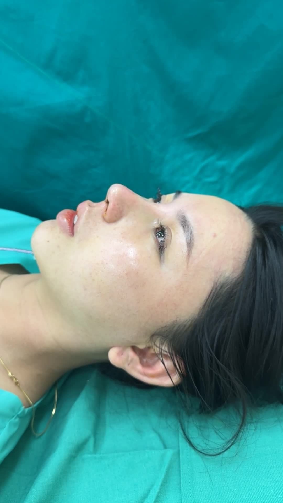 NÂNG MŨI CẤU TRÚC RÚT CHỈ SURGIFORM - DÁNG MŨI CAO BAY SẮC NÉT