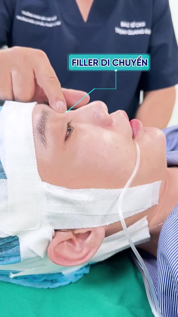 FILLER TỒN TẠI TRONG MŨI SUỐT 7 NĂM KHÔNG TAN?
