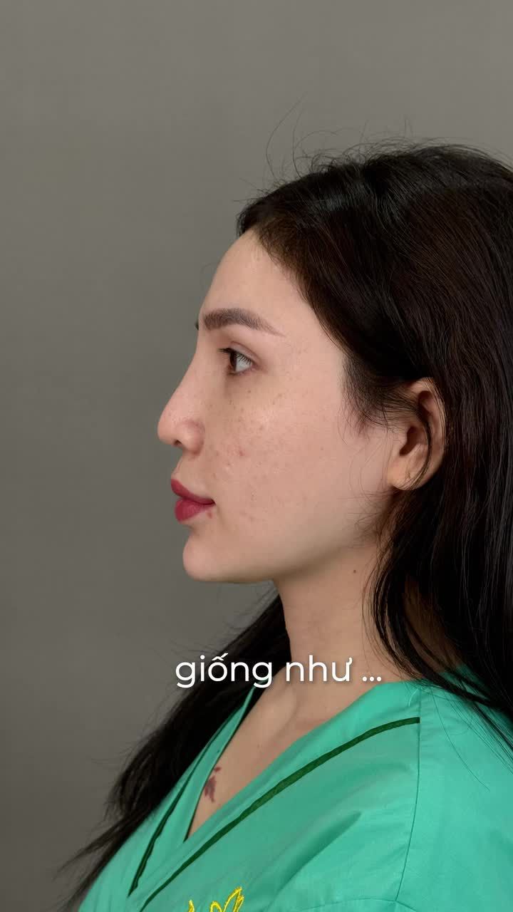 NÂNG MŨI SỬA LẠI – LẤY LẠI DÁNG MŨI ĐẸP SỰ TỰ TIN!!