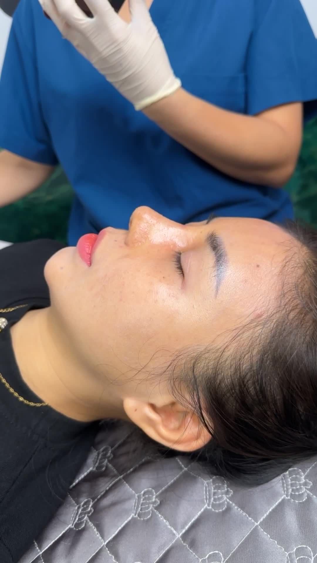 MŨI TÁI CẤU TRÚC SAU 10 NGÀY – FORM DÁNG ĐÃ ỔN ĐỊNH RÕ RỆT