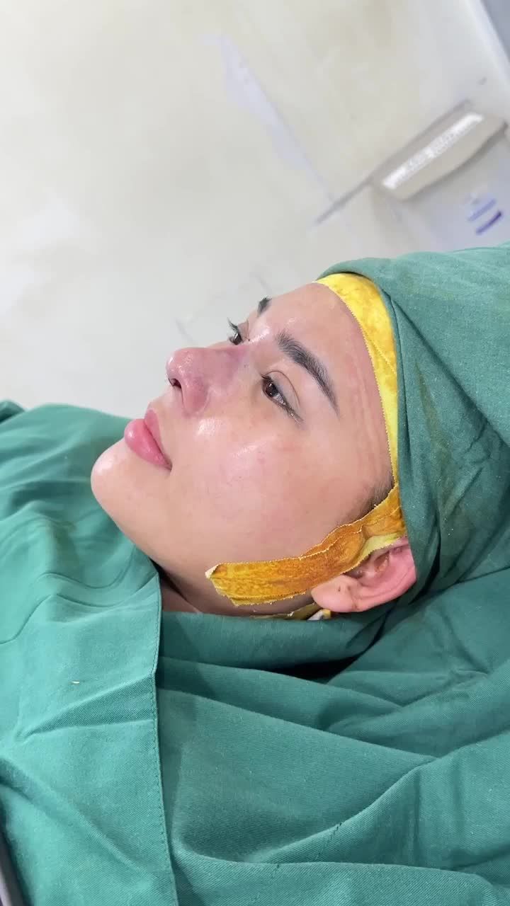 TRẢ KẾT QUẢ SAU 60 PHÚT THỰC HIỆN NÂNG MŨI CẤU TRÚC DR. HOẠT KH. HUYỀN TRÂN (ĐĂKLĂK)