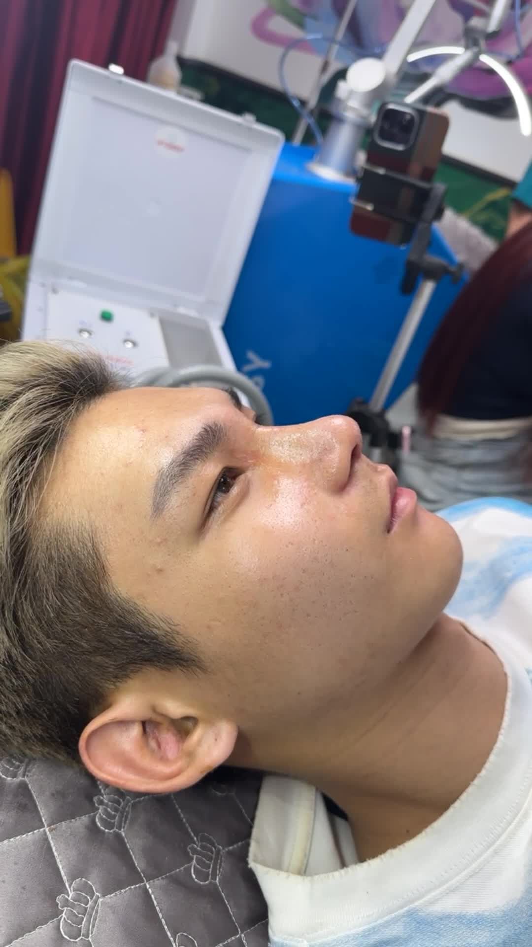 MŨI CẤU TRÚC NAM SAU 10 NGÀY TÁI KHÁM - DÁNG ỔN ĐỊNH, CHUẨN ĐẸP TỰ NHIÊN!!