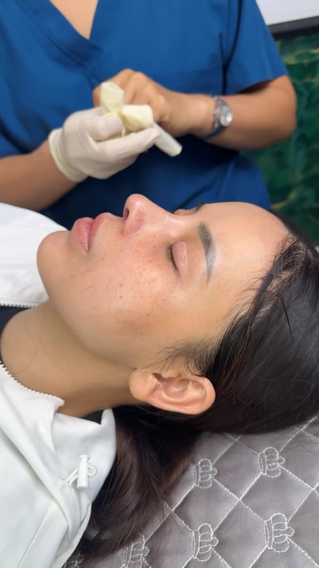 MŨI CẤU TRÚC SỬA LẠI – 10 NGÀY ĐÃ VÀO FORM RÕ NÉT