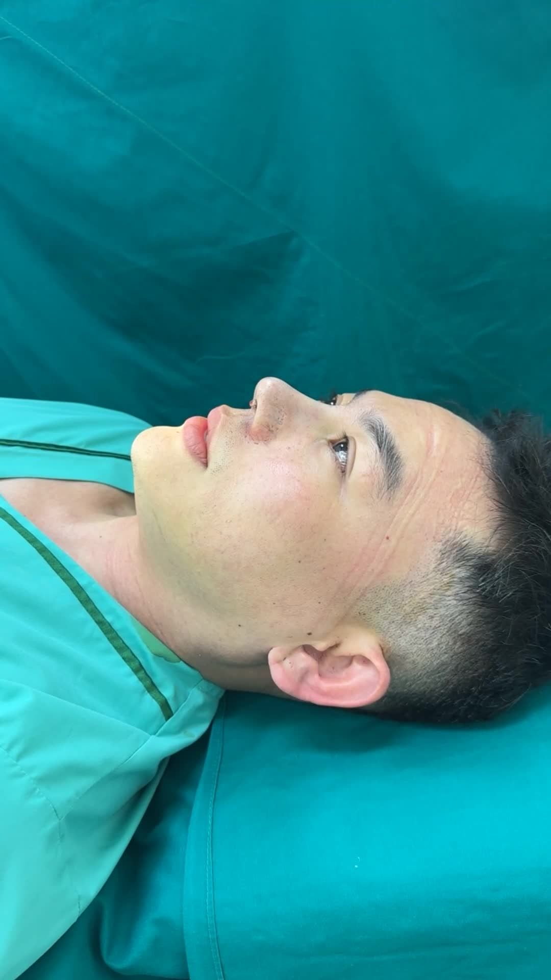 NÂNG MŨI CẤU TRÚC SỬA LẠI CHO BẠN NAM ĐẾN TỪ QUẬN 5!!