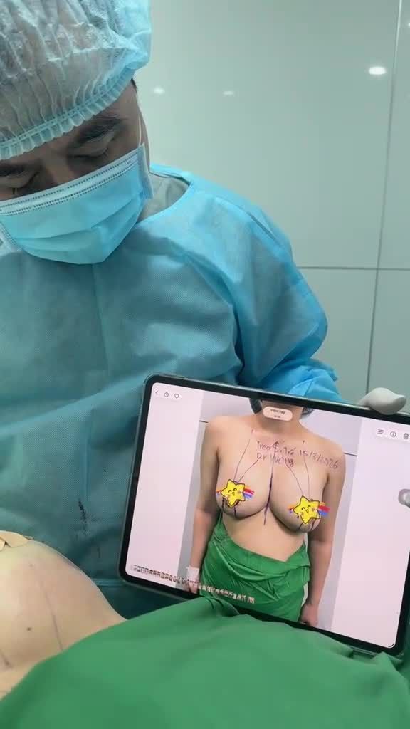 Treo ngực sa trễ (vẫn giữ nguyên túi ngực đặt trước) với Dr Vương: Hiệu quả kinh tế nhất cho các trường hợp sa trễ, sa trễ phì đại … !