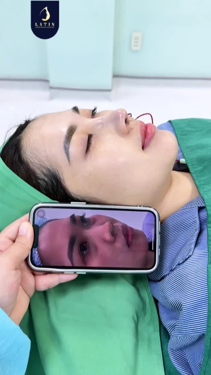 THAY ĐỔI DÁNG MŨI - GƯƠNG MẶT CŨNG TRỞ NÊN GÓC CẠNH HƠN