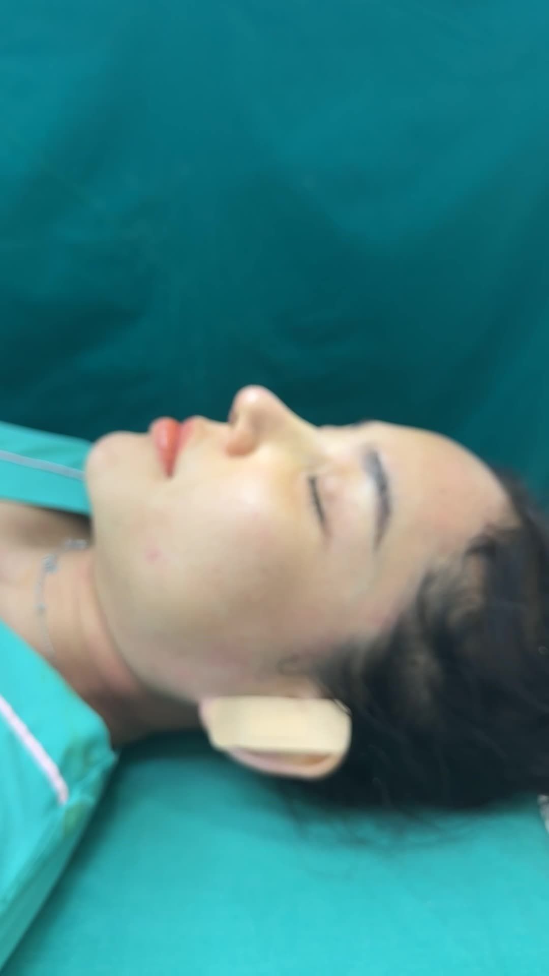 Mũi cấu trúc surgi vừa hoàn thành