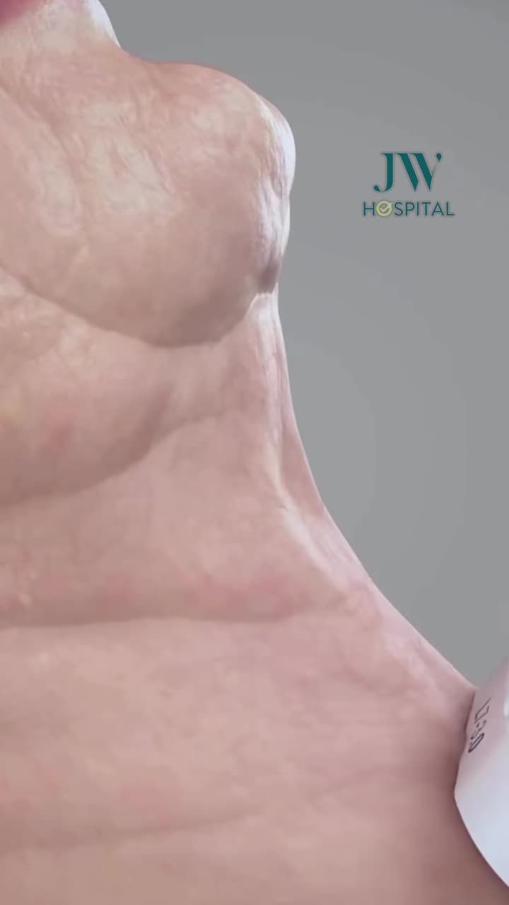 XOÁ DA CHẢY XỆ, HẾT NỌNG TRẺ ĐẸP 10 - 20 TUỔI KHÔNG PHẪU THUẬT VỚI NÂNG CƠ HIFU SMAS TẠI JW