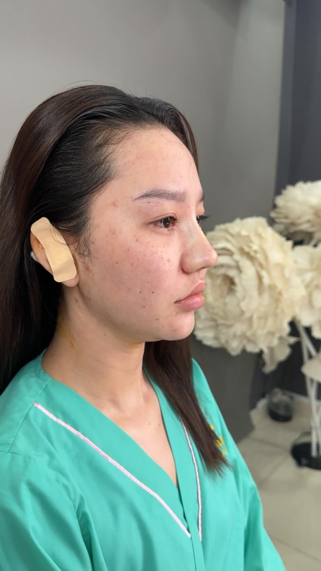 MŨI BỌC SỤN SAU PHẪU THUẬT – THẤY NGAY SỰ KHÁC BIỆT