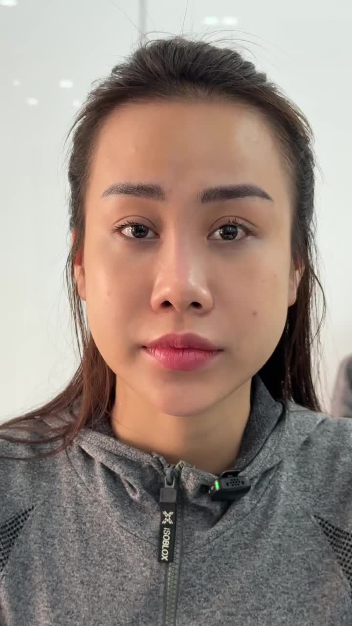 MŨI CẤU TRÚC BÓC CHỈ SAU 10 NGÀY TÁI KHÁM - ĐẸP XUẤT SẮC!!