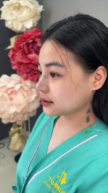 NÂNG MŨI BỌC SỤN VỪA HOÀN THÀNH - DÁNG MŨI BỀN ĐẸP VỚI CHI PHÍ ƯU ĐÃI!!