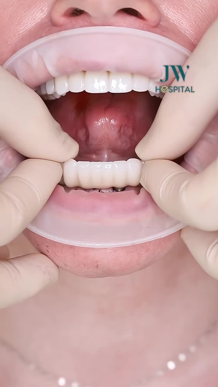 Tin Vui Cho Các Cô Chú MẤT RĂNG LÂU NĂM: Có Thể Ăn Nhai Chắc Khỏe Trở Lại Bằng TRỒNG RĂNG IMPLANT