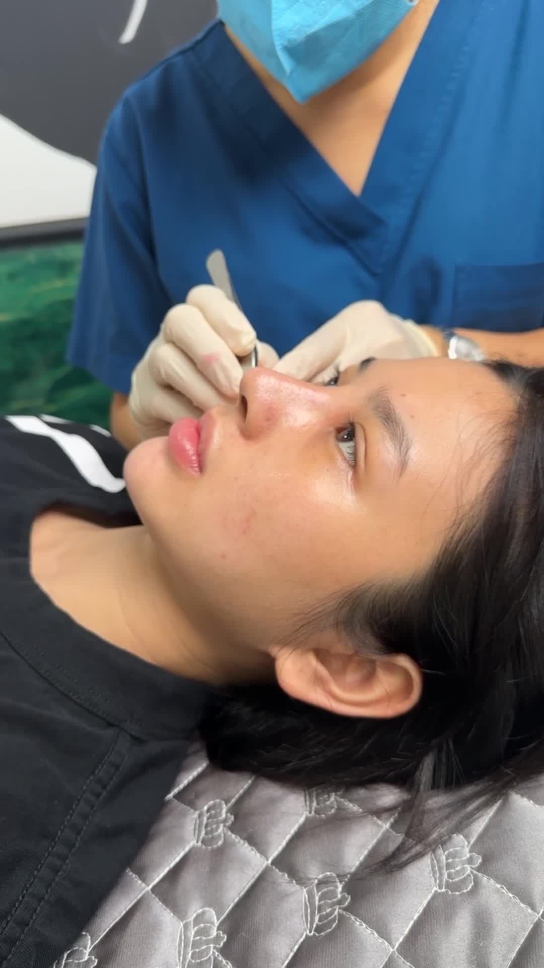 MŨI BỌC SỤN SAU 5 NGÀY – NHẸ NHÀNG, ĐÃ VÀO FORM