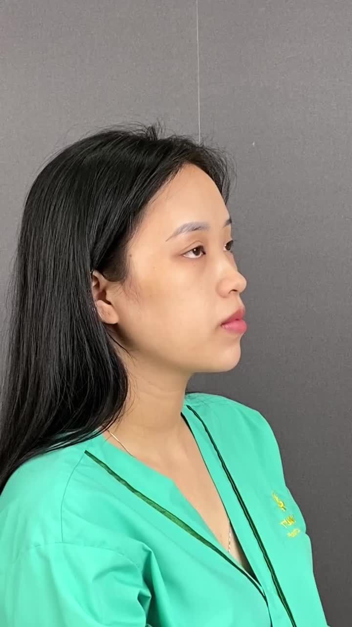 MŨI CẤU TRÚC THIẾT KẾ SAU 10 NGÀY – CHUẨN TỈ LỆ VÀNG - ĐẸP HOÀN HẢO