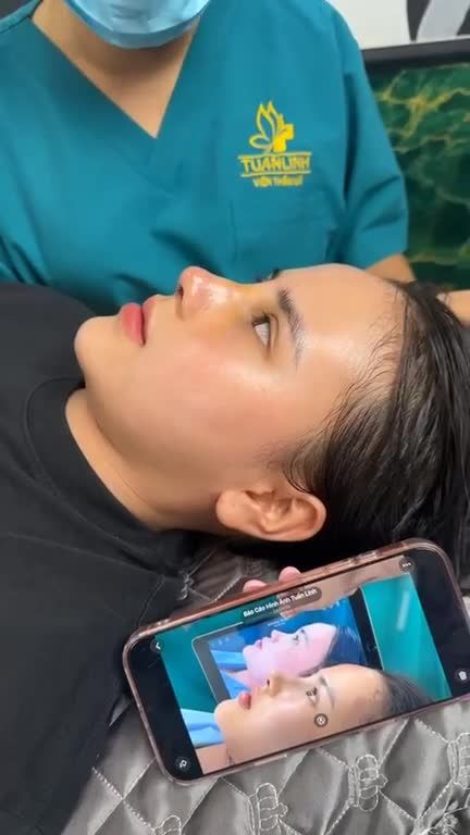 Mũi cấu trúc sau 5 ngày
