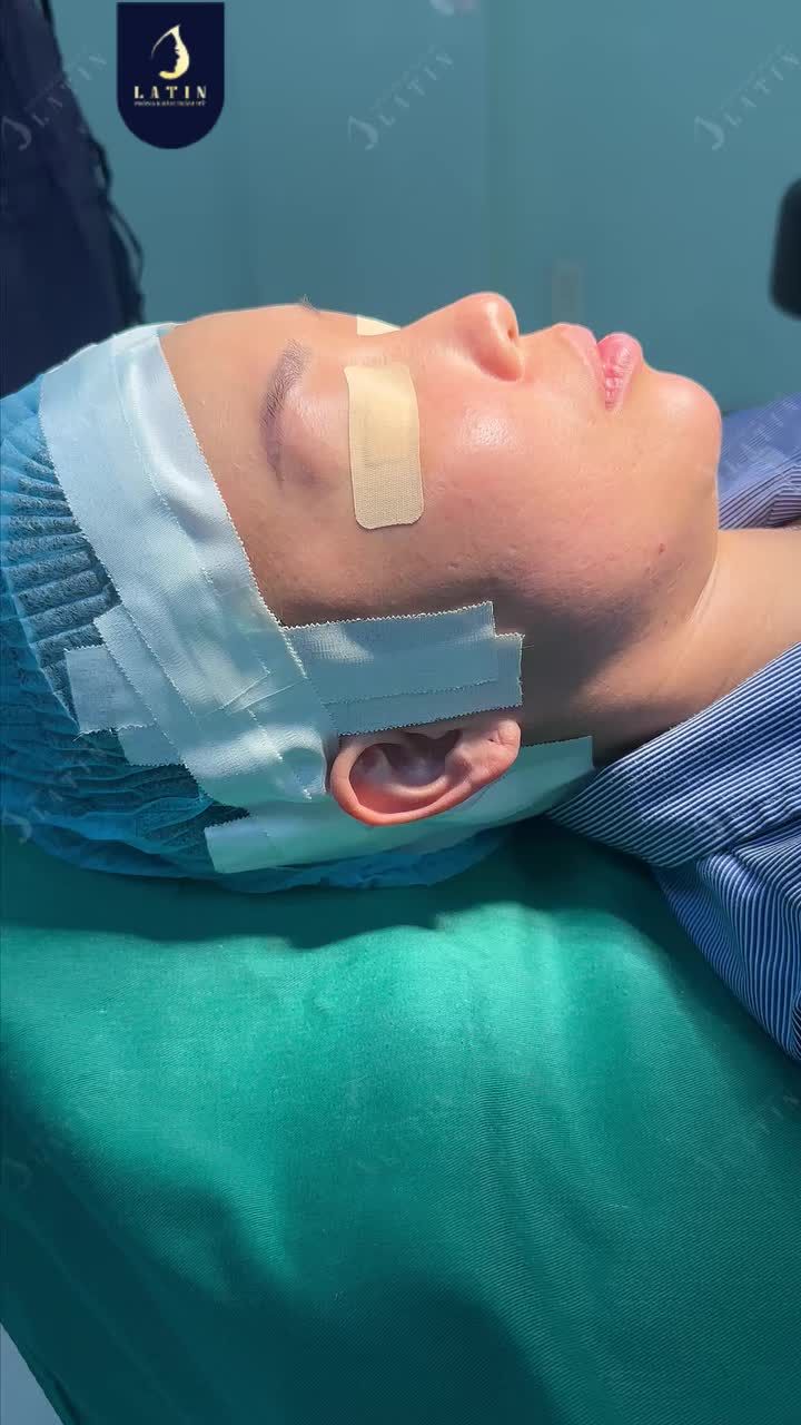 MONG MUỐN MỘT DÁNG MŨI TỰ NHIÊN HỢP MẶT