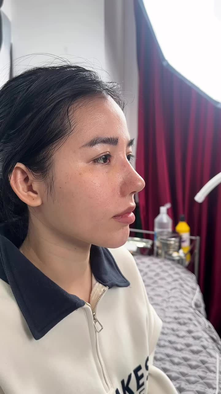 MŨI 10 NGÀY TÁI KHÁM – CASE SỬA LẠI NHƯNG FORM VÀO RẤT NHANH