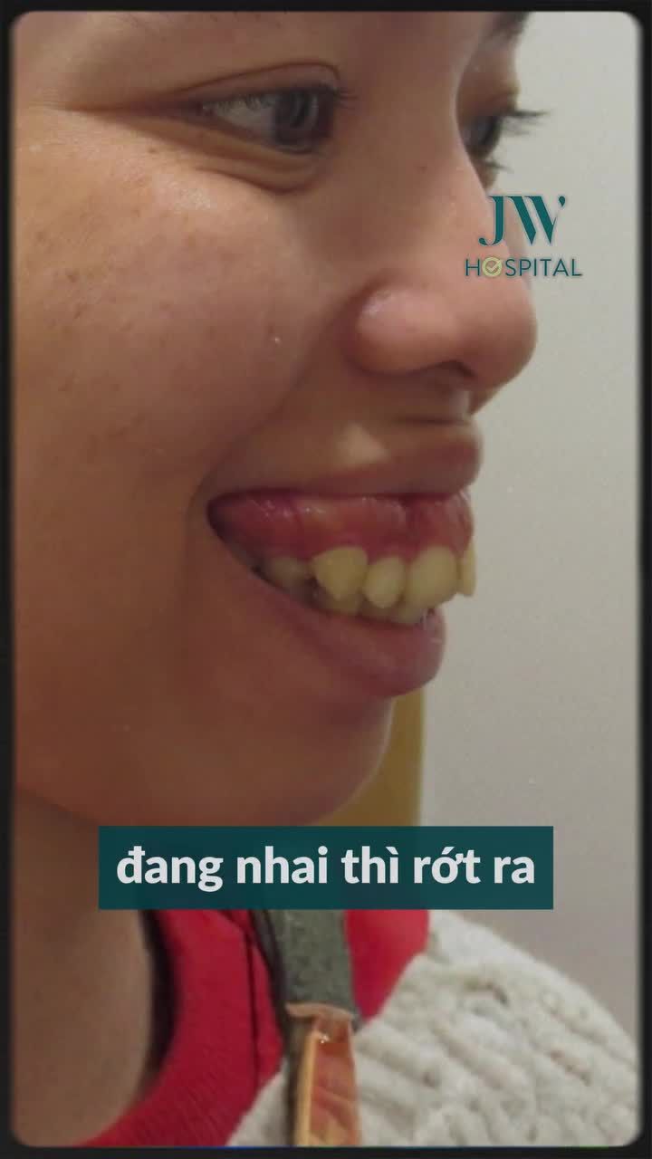 TỪ CÔ GÁI BỊ CHẾ GIỄU “NẠO DỪA” KHẮP XÓM – CÁI KẾT BẤT NGỜ SAU PHẪU THUẬT HÀM HÔ TẠI JW (P2)