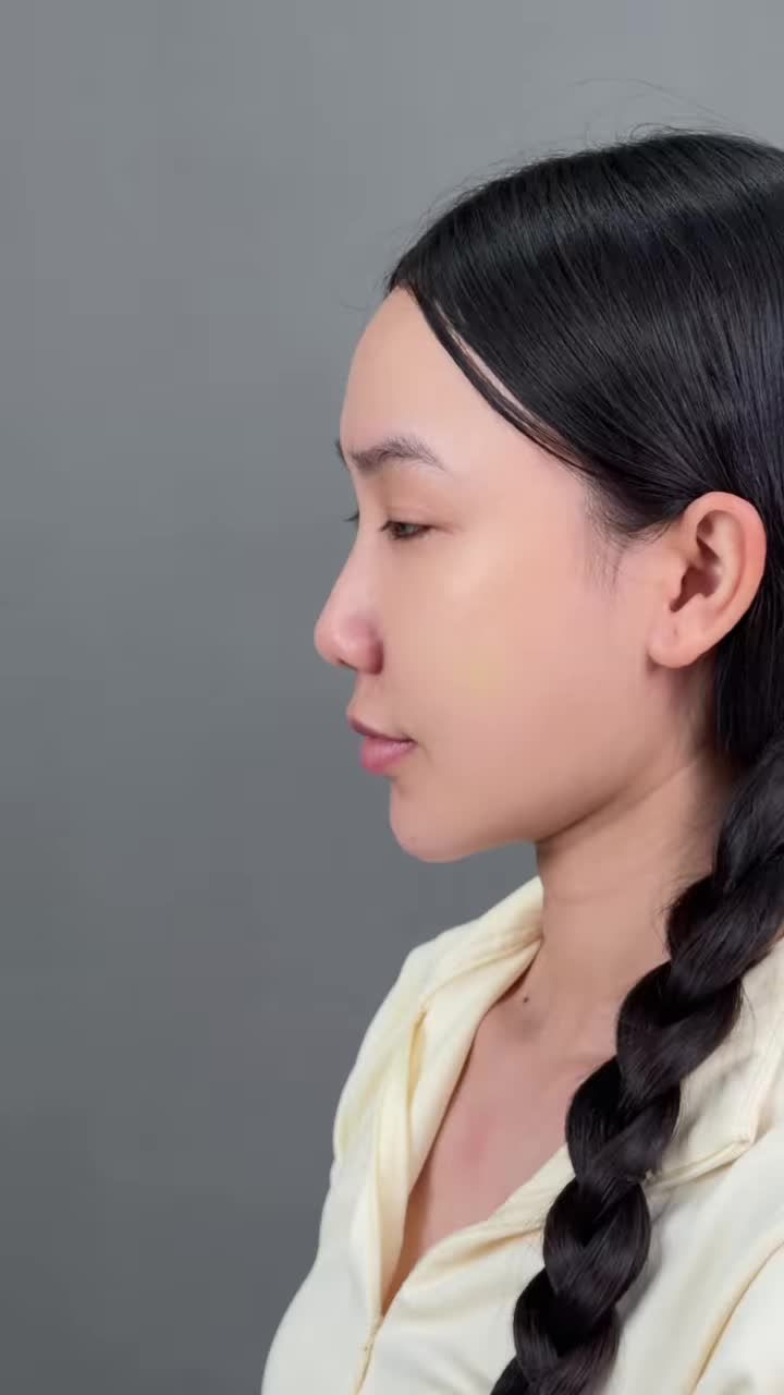 NÂNG MŨI – NHƯNG THỨ THAY ĐỔI KHÔNG CHỈ LÀ DÁNG MŨI…