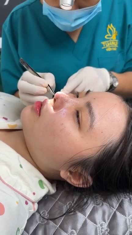 Mũi cấu trúc sau 5 ngày