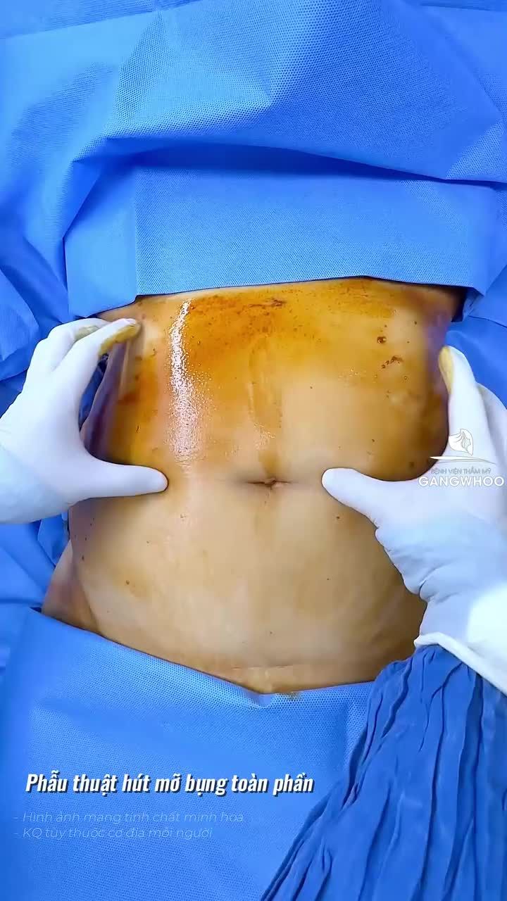 Khách Quốc tế Úc nhận kết quả ngọt ngào sau 1 tuần giảm mỡ bụng công nghệ Lipo Ultrasound