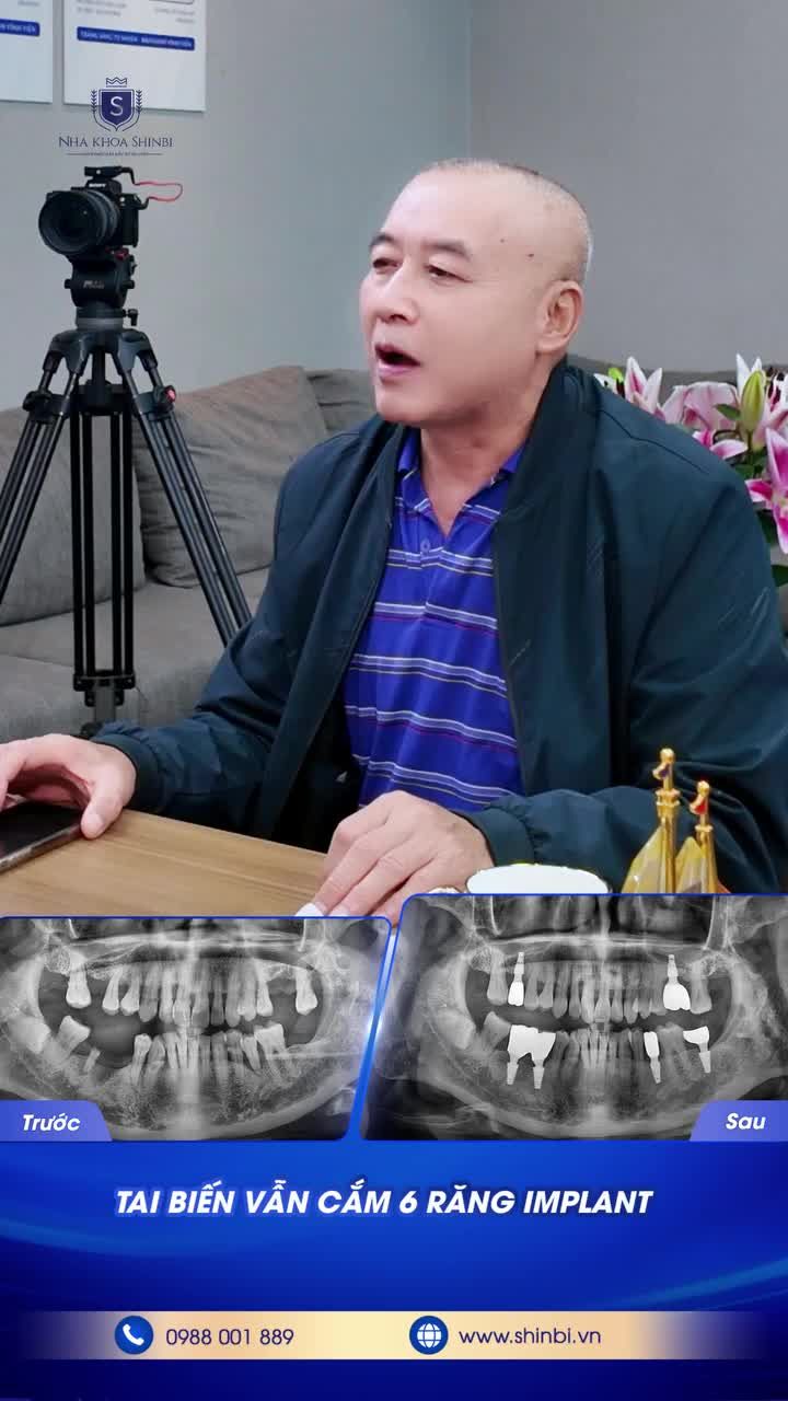 TAI BIẾN VẪN CẮM 7 IMPLANT!?