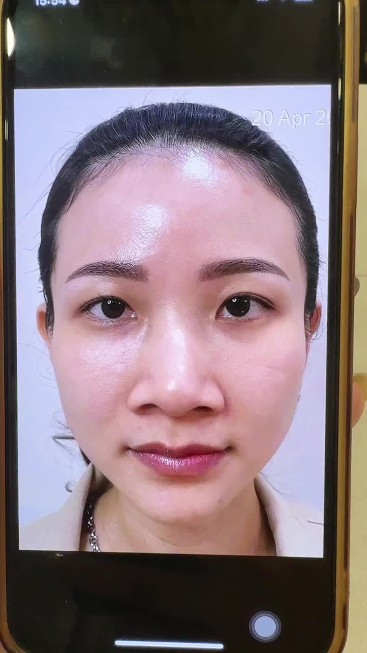 CHIÊM NGƯỠNG nhan sắc chị gái 35 tuổi sau NÂNG MŨI S LINE 3D tại JW khiến ai gặp cũng nhầm THÀNH GÁI 18