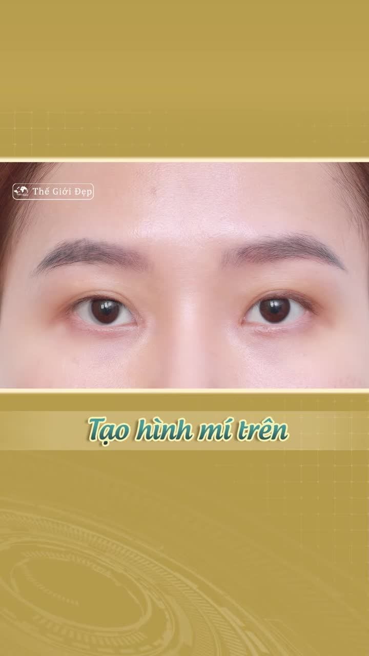 TẠO HÌNH MÍ TRÊN - Giải pháp cho đôi mắt to tròn, hài hòa và tự nhiên