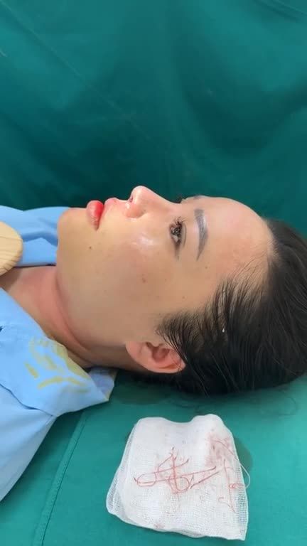 Ca nâng mũi cấu trúc rút chỉ vừa hoàn thành