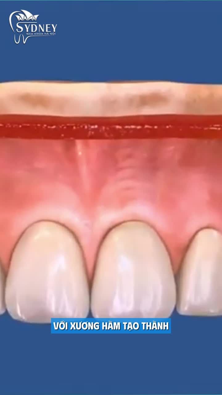 Tích hợp xương trong Implant là gì?