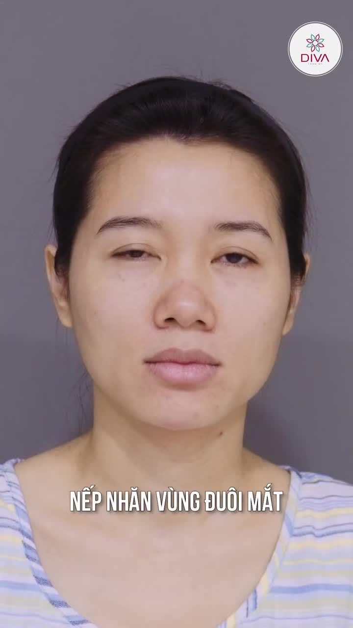 SAU KHI NÂNG MŨI TINY POINT VÀ C.ẤY M.Ỡ CẰM - KHUÔN MẶT ĐẸP DỊU DÀNG VÀ TỰ NHIÊN!