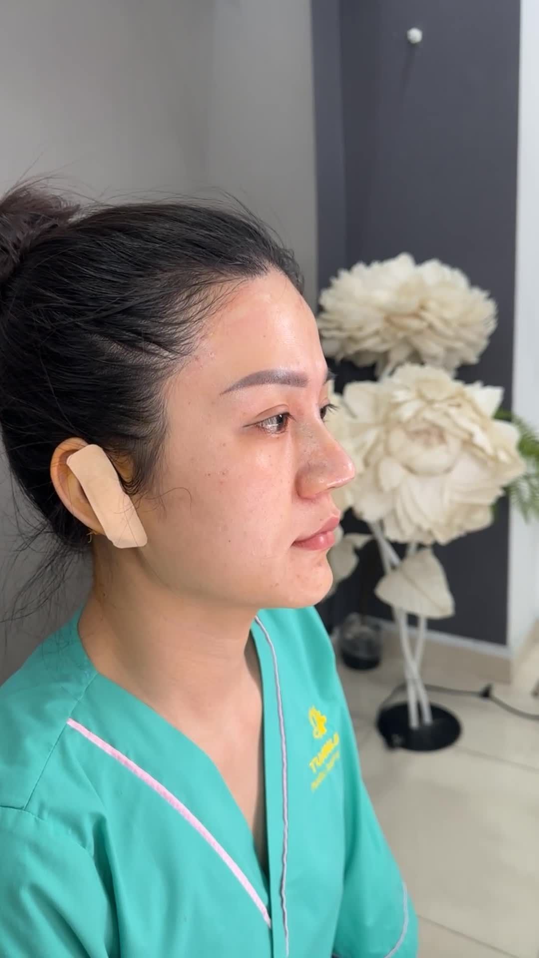 NÂNG MŨI BỌC SỤN - ĐẸP TỰ NHIÊN!!