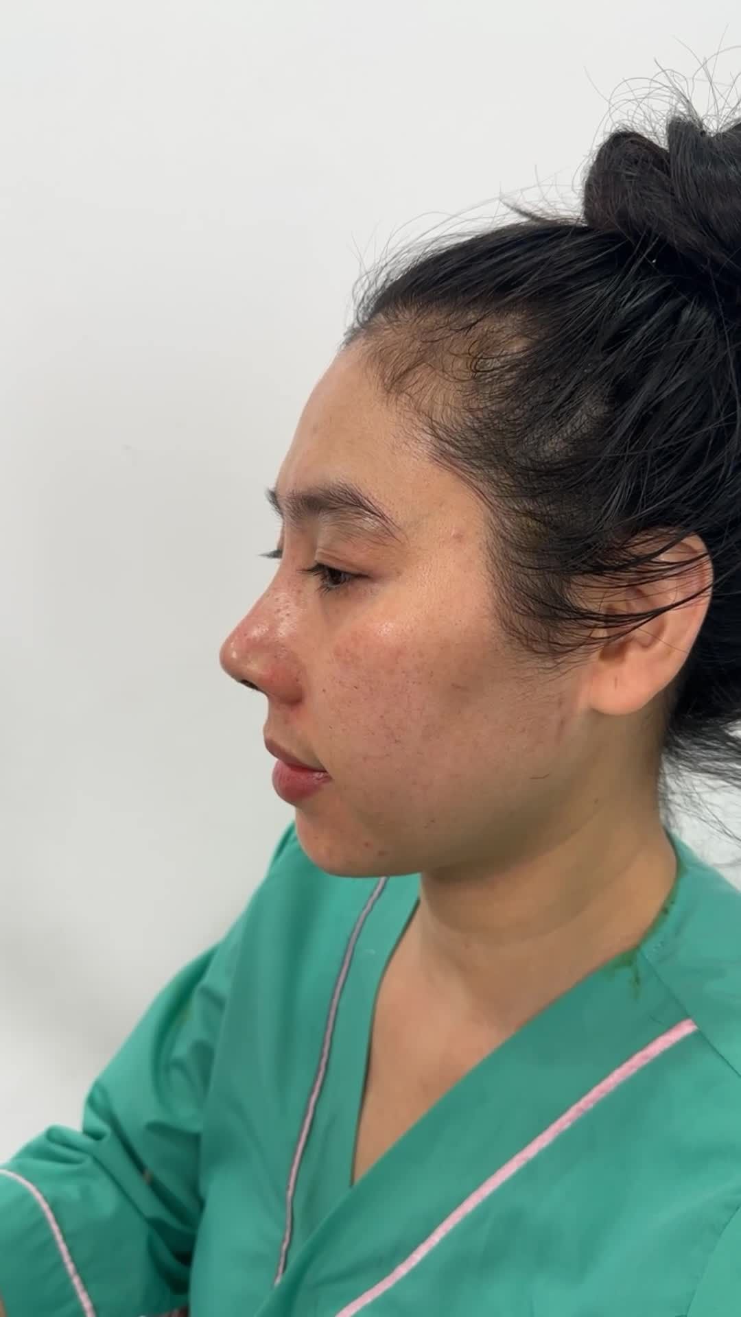 MŨI SIÊU CẤU TRÚC SỬA LẠI – “CỨU CÁNH” CHO NHỮNG DÁNG MŨI HỎNG