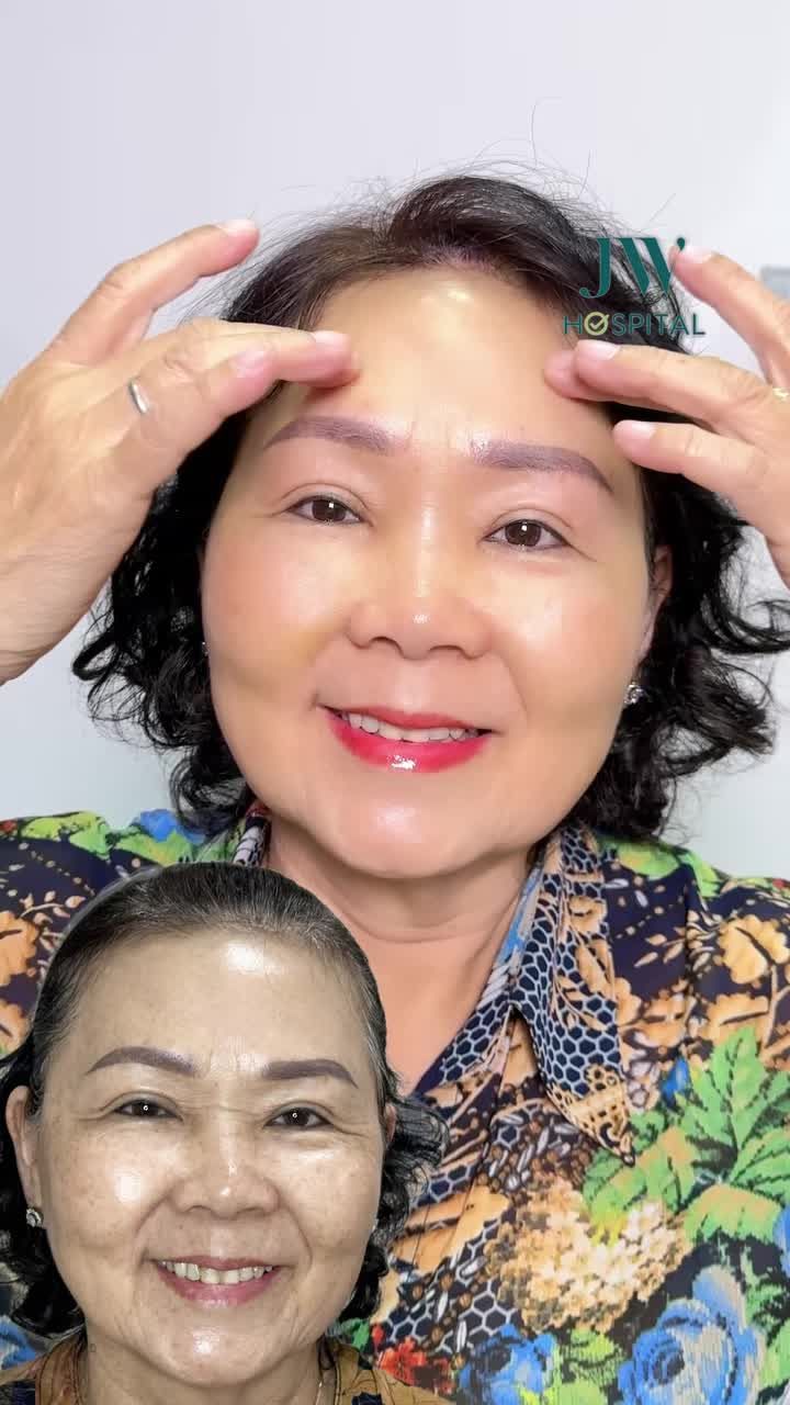 XOÁ CAU MÀY, HẾT NẾP NHĂN TRÁN CHO U70 SAU TREO CHÂN MÀY NỘI SOI SẸO VÔ HÌNH TẠI JW