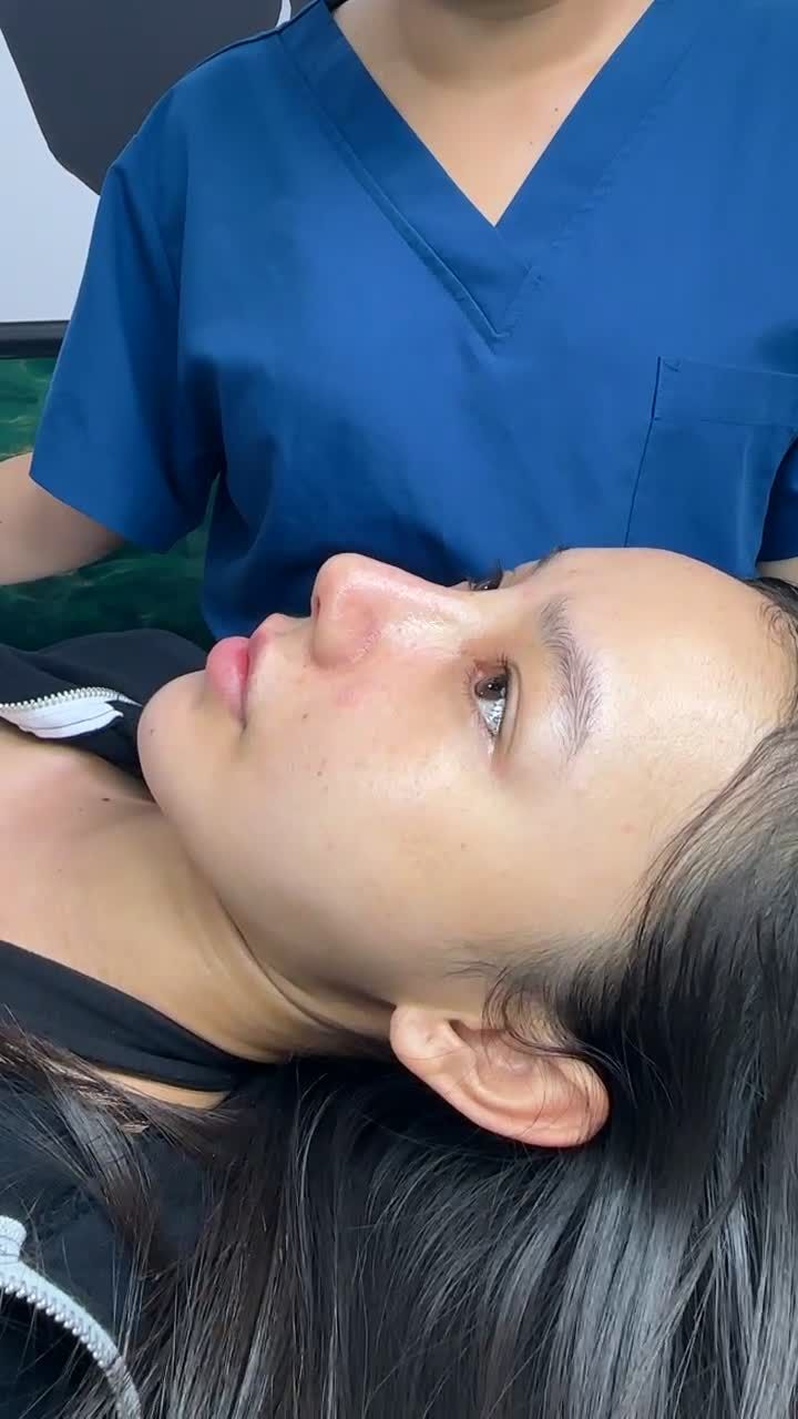 MŨI CẤU TRÚC SAU 10 NGÀY – FORM DÁNG ĐÃ RÕ NÉT