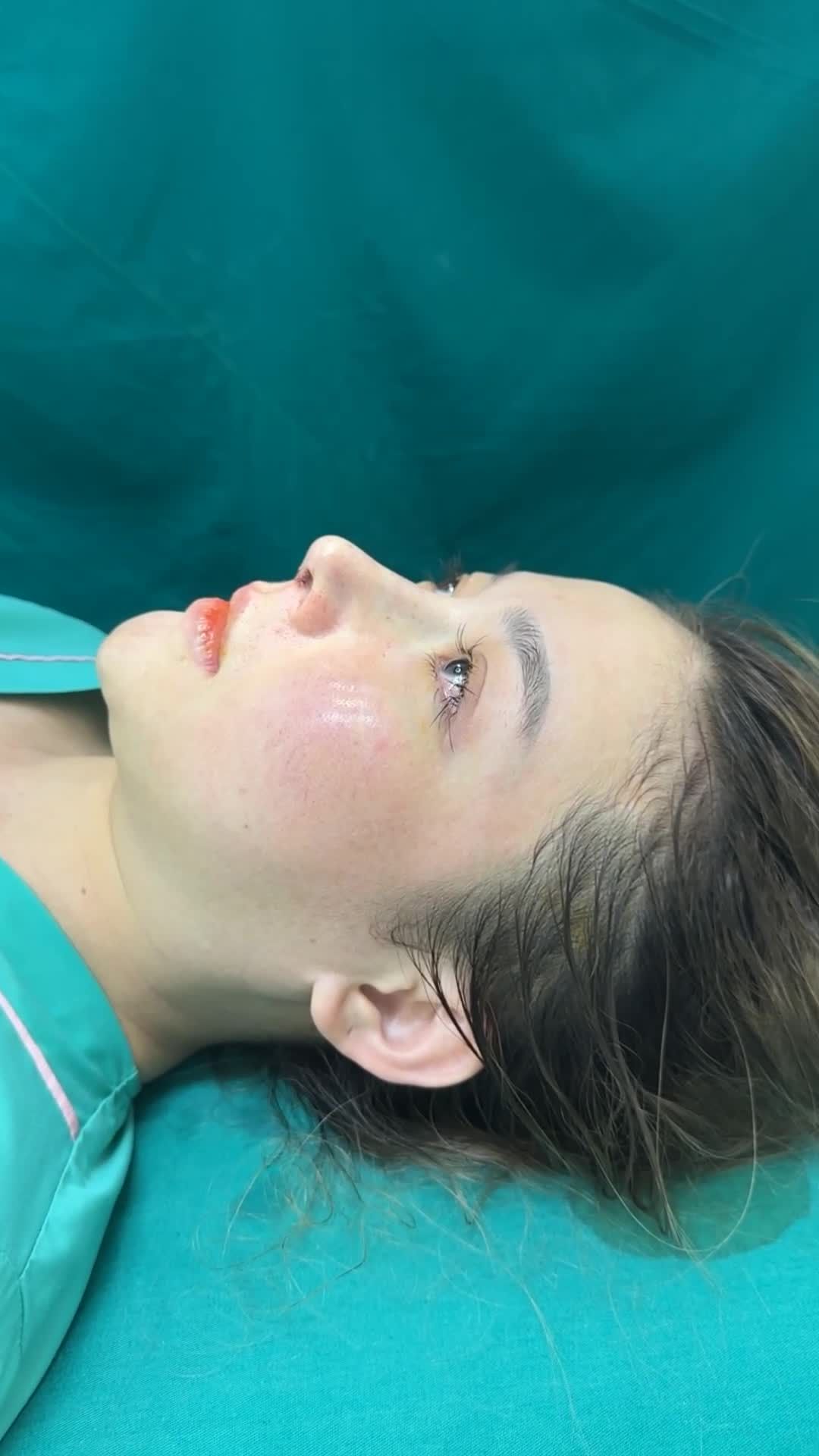 CA NÂNG MŨI CẤU TRÚC SURGIFORM HOÀN THÀNH THÀNH CÔNG