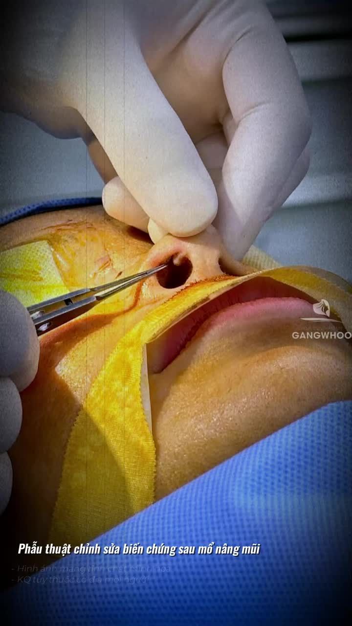 Lộ sụn, tuột sóng sau nâng mũi, nguyên nhân từ đâu?