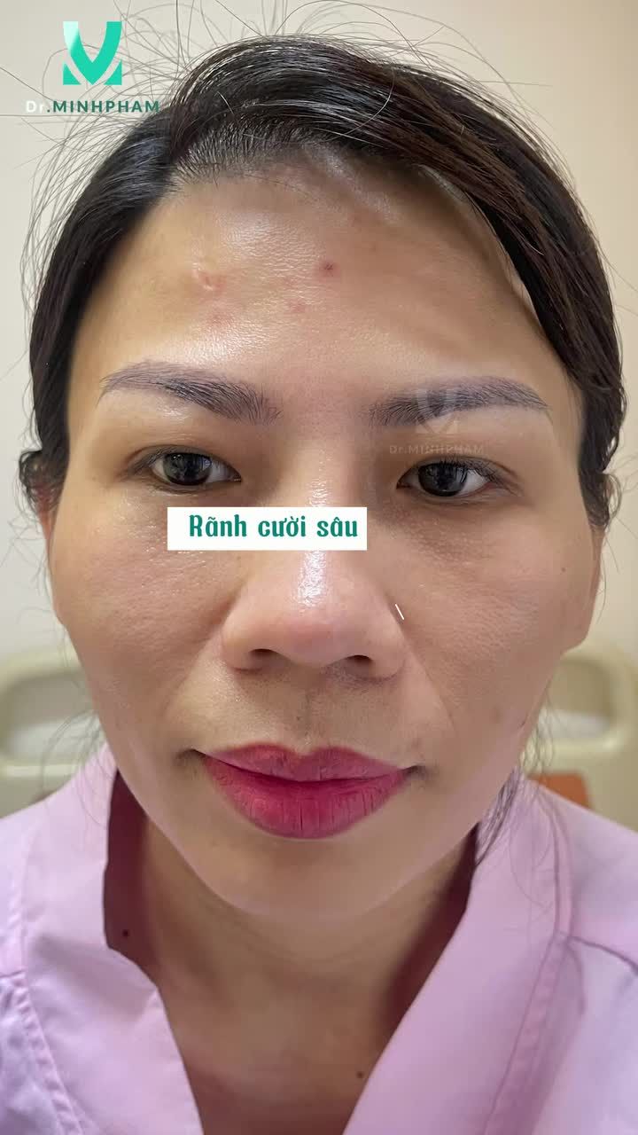 CẤY MỠ FULLFACE TRẺ HÓA TỪNG ĐƯỜNG NÉT
