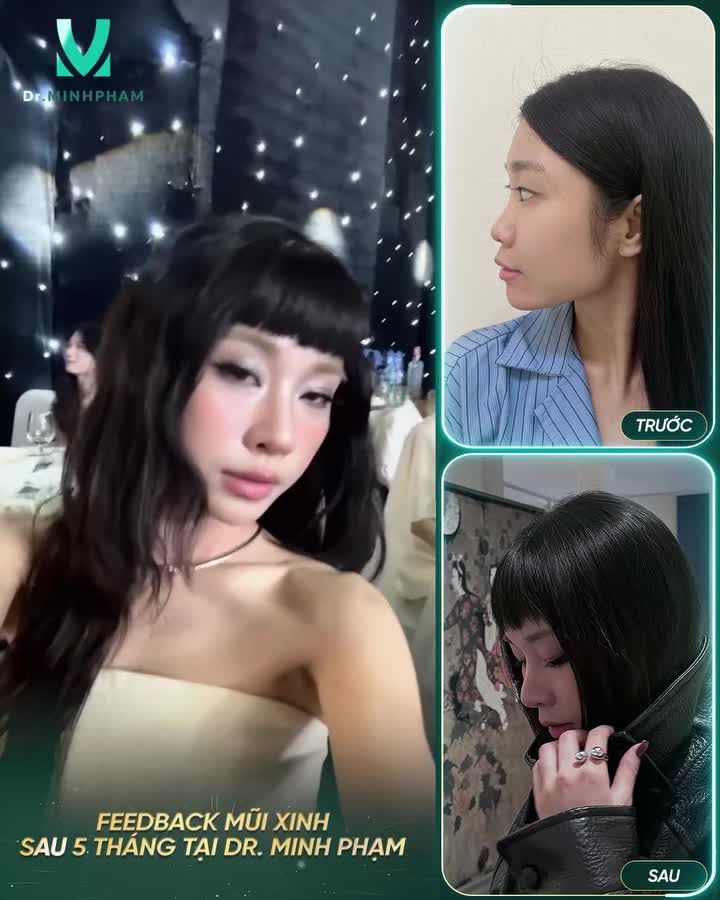 Sau 5 tháng nâng mũi, gương mặt sắc nét từng góc nhìn, mềm mại từng đường cong!