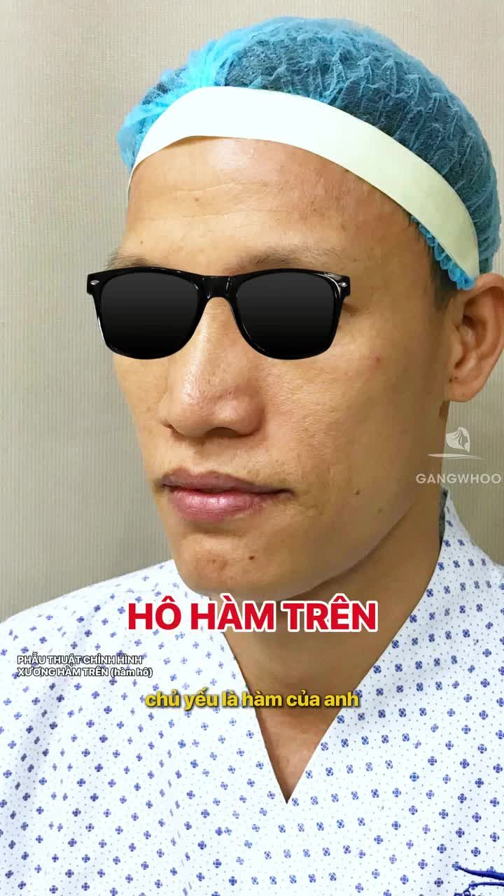 Quyết định đến Gangwhoo chỉnh hình hàm hô để có kết quả đẹp bền vững. Trải nghiệm thực tế khiến anh hài lòng với đội ngũ y bác sĩ , quy trình chuyên nghiệp và cơ sở vật chất hiện đại.