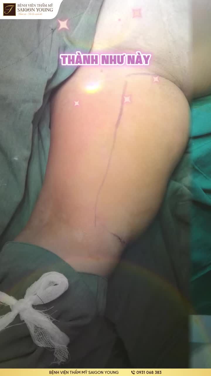 Biến "vai u thịt bắp" thành "mình hạc xương mai"