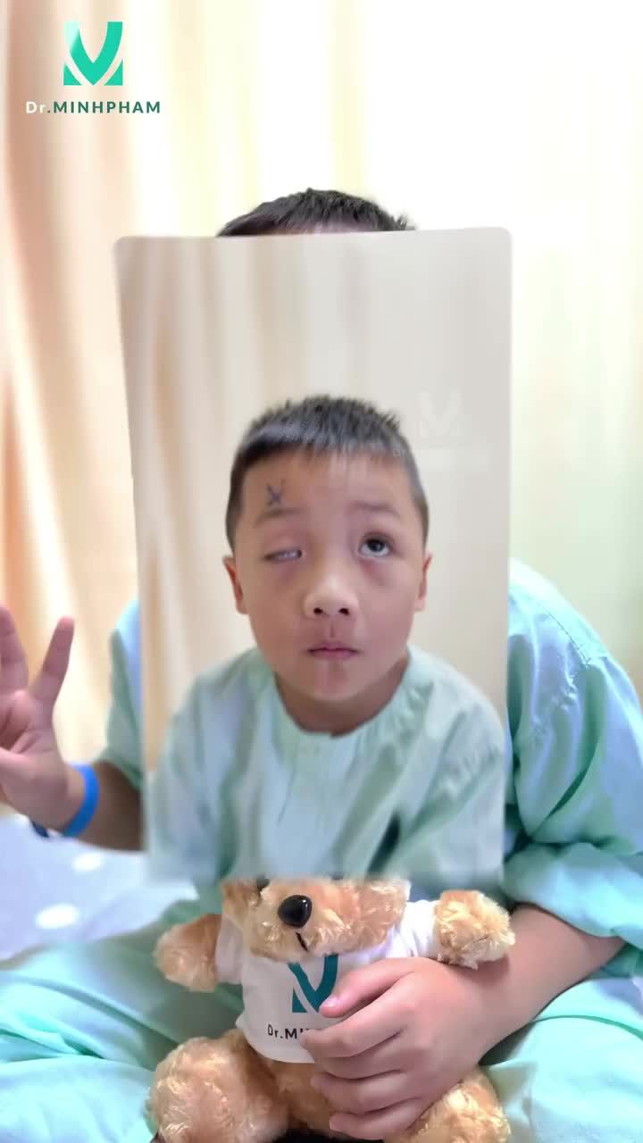 Tình trạng trước: mắt sụp mi gây ảnh hưởng đến tầm nhìn